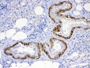 IHC testing of FFPE human intestinal cancer tissue with ACVR2A antibody at 1ug/ml. HIER: steam sections in pH6 citrate buffer for 20 min.