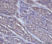 IHC testing of FFPE human liver cancer tissue with Alcohol dehydrogenase antibody. HIER: steam sections in pH8 EDTA buffer for 20 min.