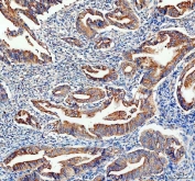 IHC staining of FFPE human colon cancer tissue with AK1 antibody. HIER: boil tissue sections in pH8 EDTA for 20 min and allow to cool before testing.