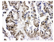IHC staining of FFPE human intestinal cancer tissue with KDM5B antibody. HIER: boil tissue sections in pH8 EDTA for 20 min and allow to cool before testing.