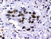 IHC staining of FFPE human lung cancer tissue with KDM5B antibody. HIER: boil tissue sections in pH8 EDTA for 20 min and allow to cool before testing.