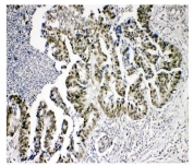 IHC staining of FFPE human intestinal cancer tissue with KDM5B antibody. HIER: boil tissue sections in pH8 EDTA for 20 min and allow to cool before testing.