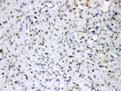IHC testing of FFPE human breast cancer tissue with ADRP antibody at 1ug/ml.  HIER: steam section in pH6 citrate buffer for 20 min.
