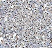 IHC staining of FFPE human lung cancer tissue with PSMA1 antibody. HIER: boil tissue sections in pH8 EDTA for 20 min and allow to cool before testing.