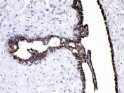 IHC testing of FFPE human breast cancer tissue with CASP8 antibody at 1ug/ml. HIER: steam section in pH6 citrate buffer for 20 min.