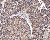 IHC staining of FFPE human hepatocellular carcinoma tissue with Angiogenin antibody. HIER: boil tissue sections in pH8 EDTA for 20 min and allow to cool before testing.