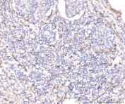 IHC staining of FFPE human lung cancer tissue with KCNQ1 antibody. HIER: boil tissue sections in pH8 EDTA for 20 min and allow to cool before testing.