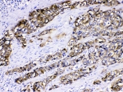 IHC testing of FFPE human esophageal SCC tissue with Cytokeratin 5 antibody at 1ug/ml. HIER: steam section in pH6 citrate buffer for 20 min.