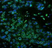 Immunofluorescent staining of FFPE human esophageal squamous cell carcinoma with Emerin antibody (green) at 1ug/ml and DAPI nuclear stain (blue). HIER: boil tissue sections in pH6, 10mM citrate buffer, for 10-20 min and allow to cool before testing.