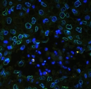 Immunofluorescent staining of FFPE human lung cancer tissue with Emerin antibody (green) at 2ug/ml and DAPI nuclear stain (blue). HIER: boil tissue sections in pH8 EDTA for 10-20 min and allow to cool before testing.