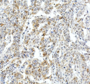 IHC staining of FFPE human liver cancer tissue with Fibrinogen beta chain antibody, HRP-secondary and DAB substrate. HIER: boil tissue sections in pH8 EDTA for 20 min and allow to cool before testing.