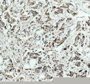 IHC staining of FFPE human breast cancer tissue with Hexokinase II antibody. HIER: boil tissue sections in pH8 EDTA for 20 min and allow to cool before testing.
