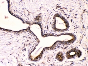 IHC testing of FFPE human breast cancer with Beta III Tubulin antibody at 1ug/ml. HIER: steam section in pH6 citrate buffer for 20 min.