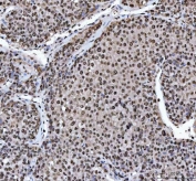 IHC staining of FFPE human liver cancer tissue with hnRNP L antibody. HIER: boil tissue sections in pH8 EDTA for 20 min and allow to cool before testing.