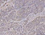 IHC staining of FFPE human liver cancer tissue with Annexin IV antibody. HIER: boil tissue sections in pH8 EDTA for 20 min and allow to cool before testing.