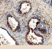 IHC staining of FFPE human prostate cancer tissue with ALDH1A3 antibody, HRP-secondary and DAB substrate. HIER: boil tissue sections in pH8 EDTA for 20 min and allow to cool before testing.