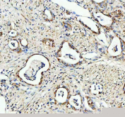 IHC staining of FFPE human pancreatic cancer tissue with Bcl-XL antibody, HRP-secondary and DAB substrate. HIER: boil tissue sections in pH8 EDTA for 20 min and allow to cool before testing.