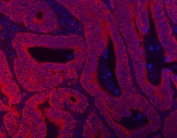 Immunofluorescent staining of FFPE human intestine cancer tissue with Beta Catenin antibody (red) and DAPI nuclear stain (blue). HIER: boil tissue sections in pH8 EDTA for 20 min and allow to cool before testing.