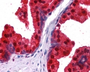 IHC testing of FFPE human prostate tissue with NDRG1 antibody at 2.5ug/ml. Required HIER: steamed antigen retrieval with pH6 citrate buffer; AP-staining.