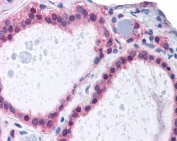 IHC testing of FFPE human thyroid tissue with ADAM17 antibody at 3.75ug/ml. HIER: steamed antigen retrieval with pH6 citrate buffer; AP-staining.