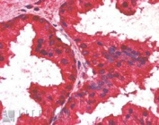 IHC staining of FFPE human prostate with AIBZIP antibody at 2.5ug/ml. HIER: steamed with pH6 citrate buffer, AP-staining.