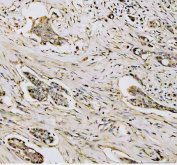 IHC staining of FFPE human breast cancer tissue with Dnmt1 antibody, HRP-secondary and DAB substrate. HIER: boil tissue sections in pH8 EDTA for 20 min and allow to cool before testing.