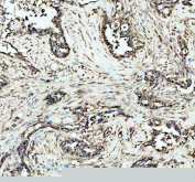 IHC staining of FFPE human pancreatic cancer tissue with Dnmt1 antibody, HRP-secondary and DAB substrate. HIER: boil tissue sections in pH8 EDTA for 20 min and allow to cool before testing.