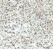 IHC testing of FFPE human gastric cancer tissue with PER1 antibody at 1ug/ml. Required HIER: steam section in pH8 EDTA buffer for 20 min and allow to cool prior to testing.