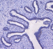IHC testing of FFPE human breast cancer tissue with CD41 antibody at 1ug/ml. Required HIER: steam section in pH6 citrate buffer for 20 min and allow to cool prior to testing.