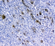 IHC staining of FFPE human rectal cancer with 14-3-3 sigma antibody at 1ug/ml. HIER: boil tissue sections in pH6, 10mM citrate buffer, for 10-20 min and allow to cool before testing.