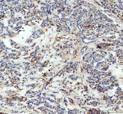 IHC staining of FFPE human pancreatic cancer tissue with CFD antibody. Required HIER: steam section in pH8 EDTA buffer for 20 min and allow to cool prior to testing.
