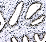 IHC testing of FFPE human breast cancer tissue with CBX3 antibody at 1ug/ml. Required HIER: steam section in pH6 citrate buffer for 20 min and allow to cool prior to testing.