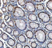 IHC staining of FFPE human colon cancer tissue with GALT antibody. HIER: boil tissue sections in pH8 EDTA for 20 min and allow to cool before testing.