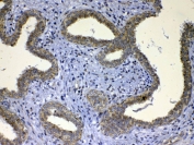 IHC testing of FFPE human breast cancer tissue with UGT1A1 antibody at 1ug/ml. Required HIER: steam section in pH6 citrate buffer for 20 min and allow to cool prior to testing.