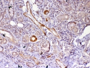 IHC testing of FFPE human lung cancer tissue with FZD4 antibody at 1ug/ml. Required HIER: steam section in pH6 citrate buffer for 20 min and allow to cool prior to testing.