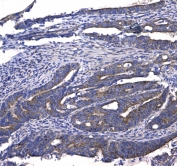 IHC testing of FFPE human rectal cancer tissue with GSTM3 antibody at 1ug/ml. Required HIER: steam section in pH6 citrate buffer for 20 min and allow to cool prior to testing.