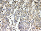 IHC testing of FFPE human lung cancer tissue with TSPAN12 antibody. Required HIER: steam section in pH6 citrate buffer for 20 min and allow to cool prior to testing.
