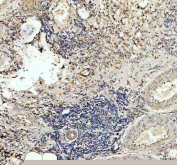 IHC staining of FFPE human lung cancer tissue with TSPAN12 antibody, HRP-labeled secondary and DAB substrate. HIER: boil tissue sections in pH8 EDTA for 20 min and allow to cool before testing.