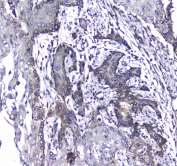 IHC testing of FFPE human glioma with L1CAM antibody at 1ug/ml. Required HIER: steam section in pH6 citrate buffer for 20 min and allow to cool prior to staining.