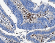 IHC staining of FFPE human rectal cancer with CD16 antibody. HIER: boil tissue sections in pH8 EDTA for 20 min and allow to cool before testing.