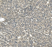 IHC staining of FFPE human liver cancer tissue with Serum Amyloid P antibody. HIER: boil tissue sections in pH8 EDTA for 20 min and allow to cool before testing.