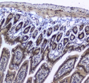 IHC testing of FFPE human rectal cancer tissue with SF1 antibody at 1ug/ml. Required HIER: steam section in pH6 citrate buffer for 20 min and allow to cool prior to staining.