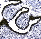 IHC testing of FFPE human breast cancer tissue with STUB1 antibody at 1ug/ml. Required HIER: steam section in pH6 citrate buffer for 20 min and allow to cool prior to staining.