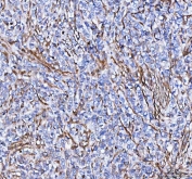 IHC staining of FFPE human breast cancer tissue with S100A10 antibody. HIER: boil tissue sections in pH8 EDTA for 20 min and allow to cool before testing.