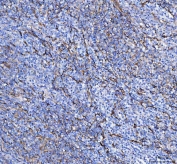 IHC staining of FFPE human intestinal diffuse large B-cell lymphoma tissue with S100A10 antibody. HIER: boil tissue sections in pH8 EDTA for 20 min and allow to cool before testing.
