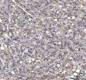 IHC staining of FFPE human liver cancer tissue with S100A10 antibody. HIER: boil tissue sections in pH8 EDTA for 20 min and allow to cool before testing.