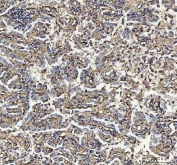IHC staining of FFPE human lung adenocarcinoma tissue with S100A10 antibody. HIER: boil tissue sections in pH8 EDTA for 20 min and allow to cool before testing.