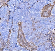 IHC staining of FFPE human ovarian serous adenocarcinoma tissue with S100A10 antibody. HIER: boil tissue sections in pH8 EDTA for 20 min and allow to cool before testing.