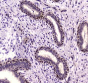 IHC testing of FFPE human breast cancer tissue with NFIB antibody at 1ug/ml. Required HIER: steam section in pH6 citrate buffer for 20 min and allow to cool prior to staining.
