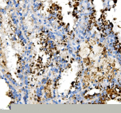 IHC testing of FFPE human renal cancer tissue with NPC2 antibody at 2ug/ml. Required HIER: steam section in pH6 citrate buffer for 20 min and allow to cool prior to staining.